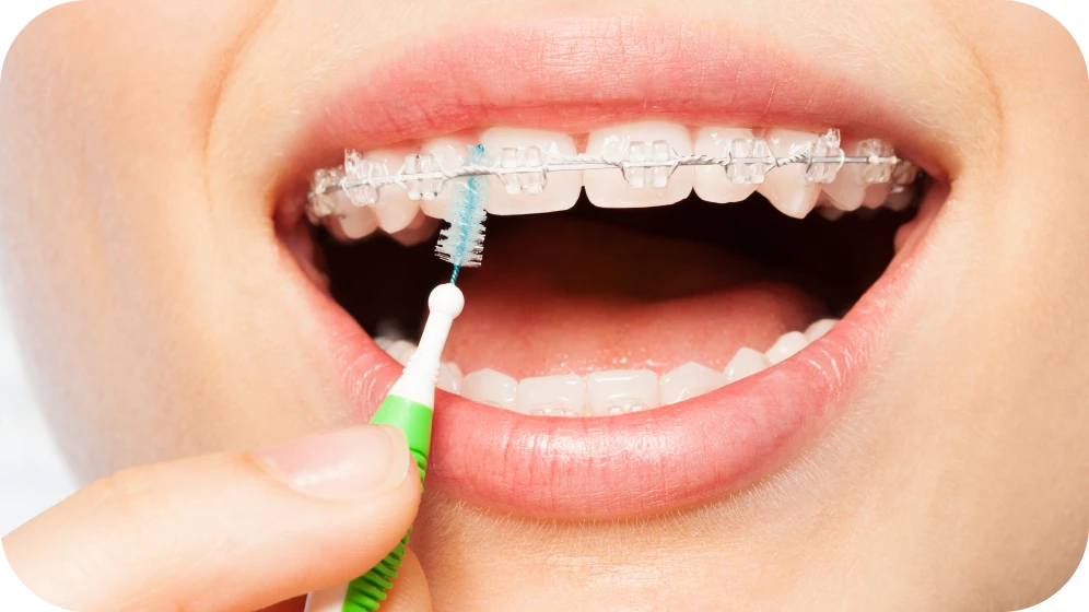 appareils dentaires adultes grenoble appareils dentaires adultes grenoble Appareils dentaires Cabinet d’orthodontie Drs. ROCCA & Associés