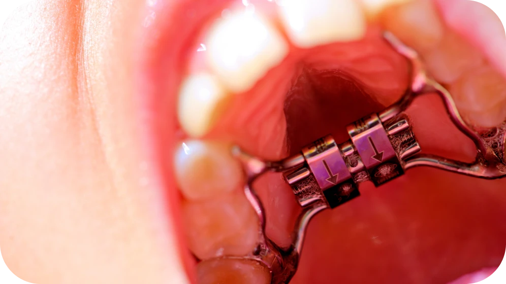 traitement disjoncteur maxillaire grenoble traitement disjoncteur maxillaire grenoble Disjoncteur Cabinet d’orthodontie Drs. ROCCA & Associés